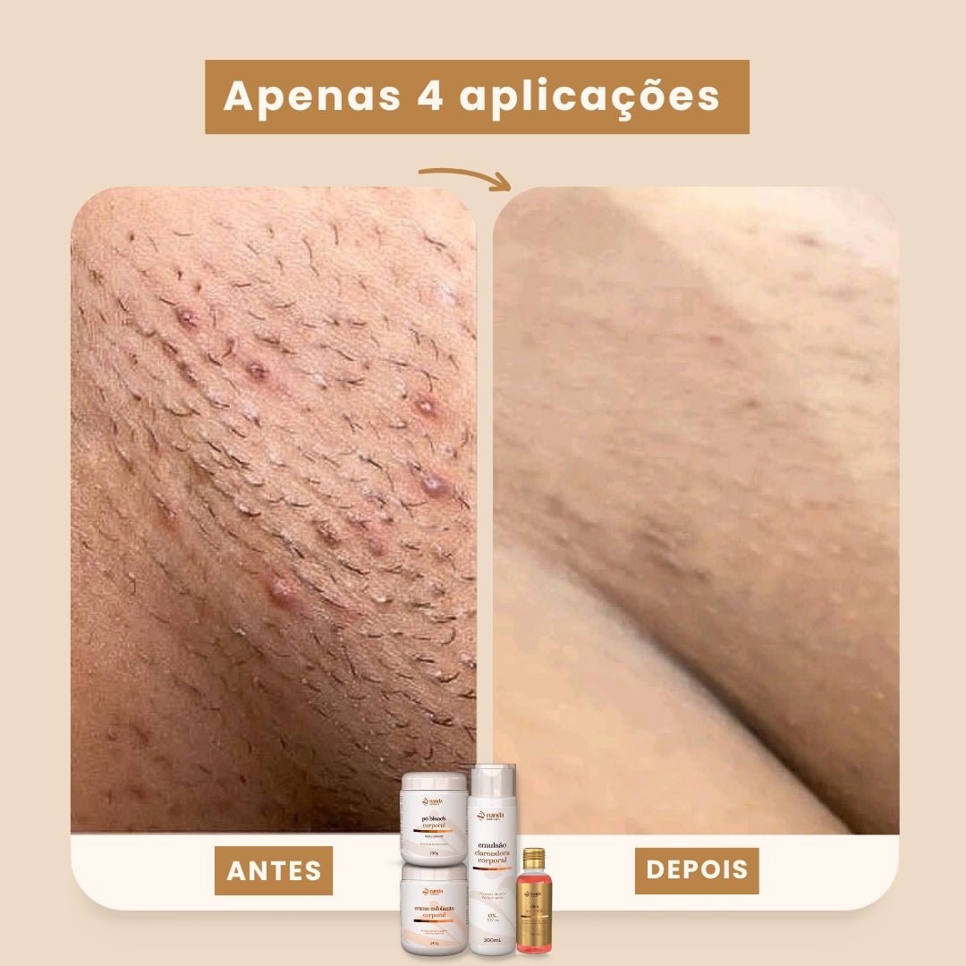 Kit Clareador Nanda Intimus + Depilador Anti Foliculite - Tratamento Definitivo