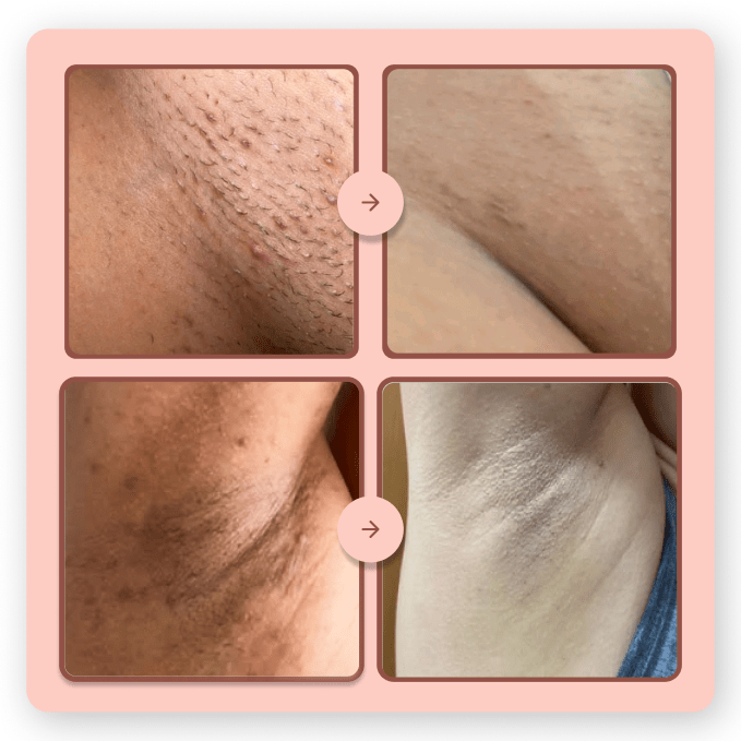 Depilador Anti Foliculite Nanda Intimus