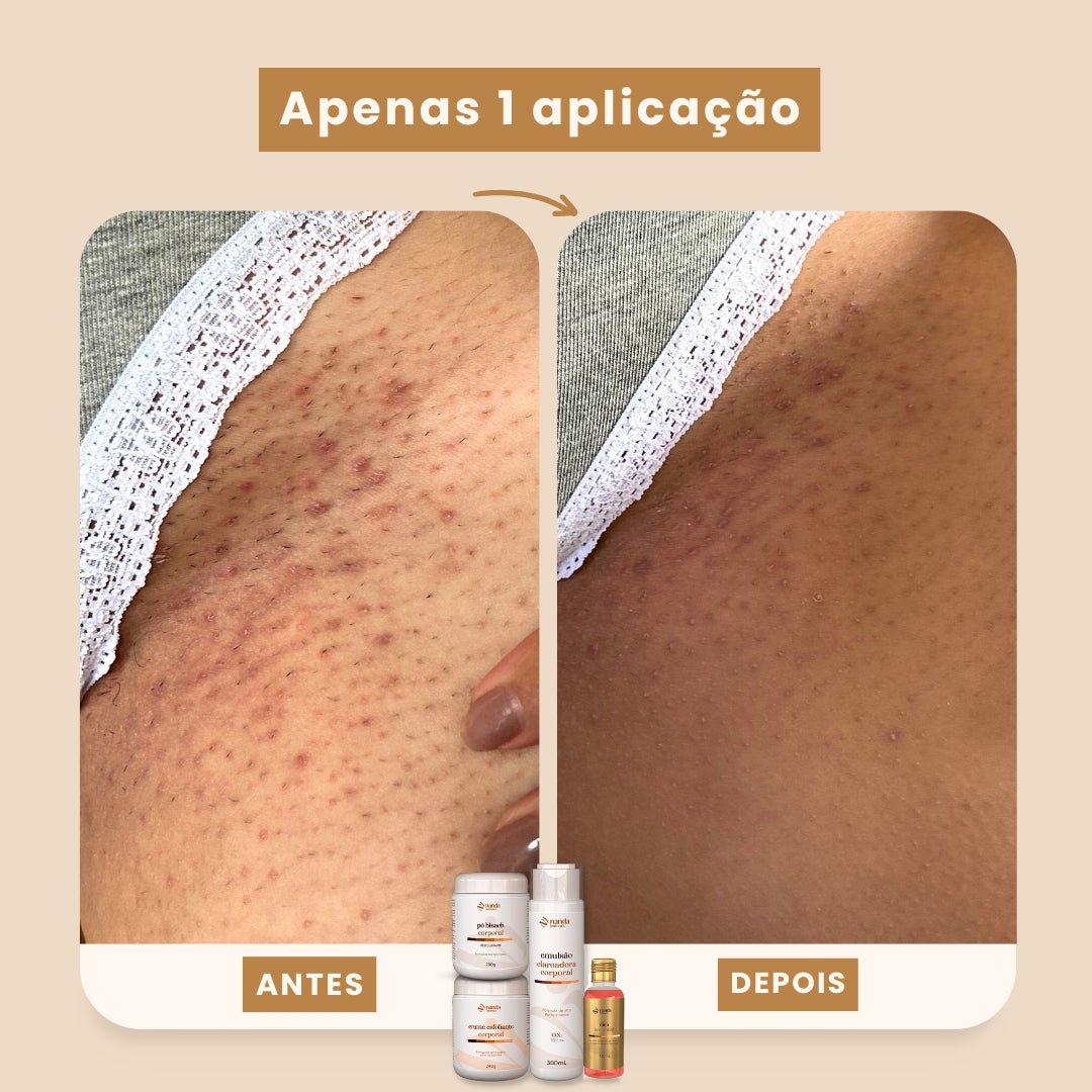 Kit Clareador Nanda Intimus + Depilador Anti Foliculite - Tratamento Definitivo